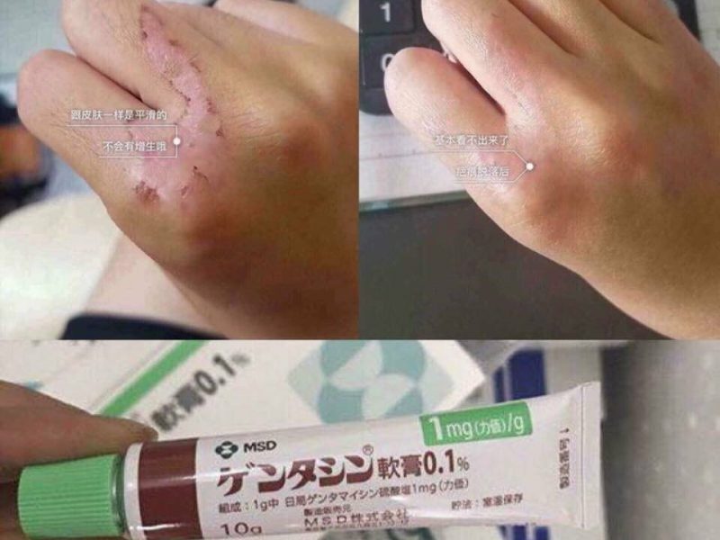 [HCM]Gel trị Sẹo Gentacin Nhật Tuýp 10g