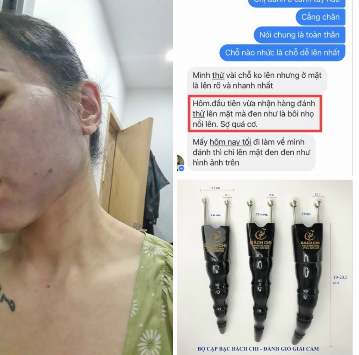 Bọ cạp sừng chân bạc Bách Chi - Đánh gió, giải cảm