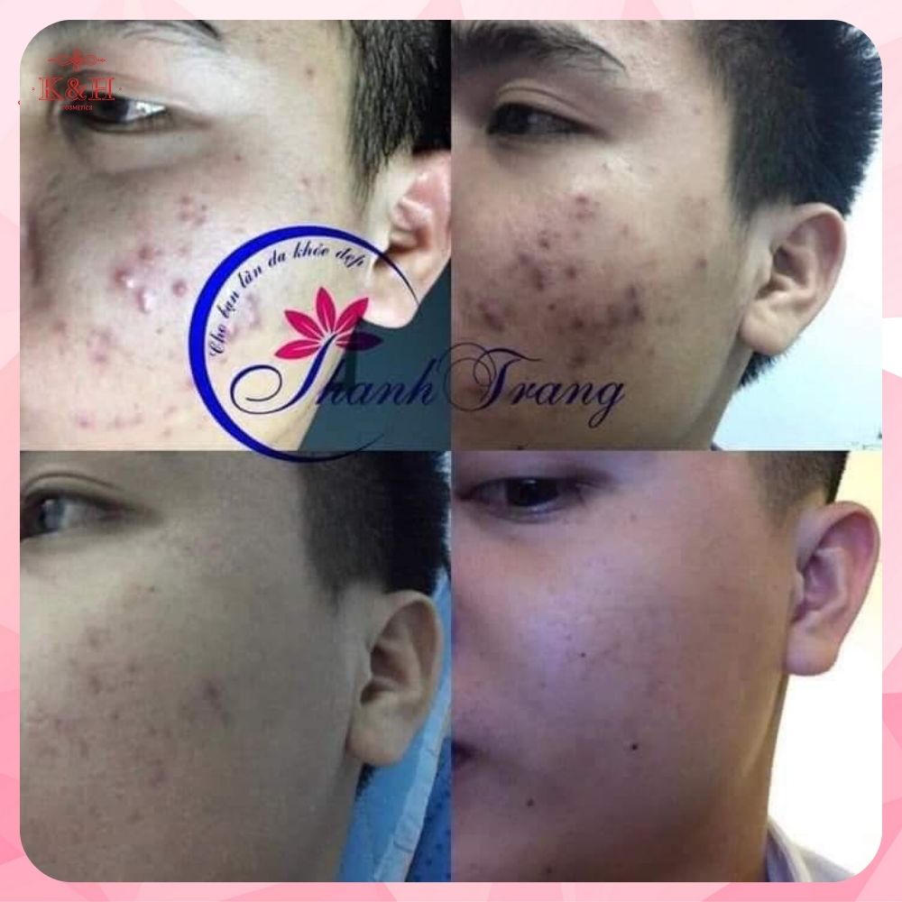 [HCM]Linh Chi Vi Mụn Tái Tạo Da Cấp Tốc Thanh Trang