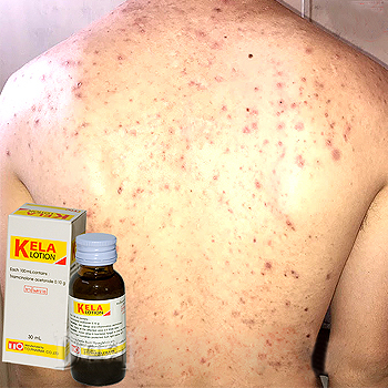 Kela Lotion Trị Viêm Lỗ Chân Lông Thái Lan 30ml