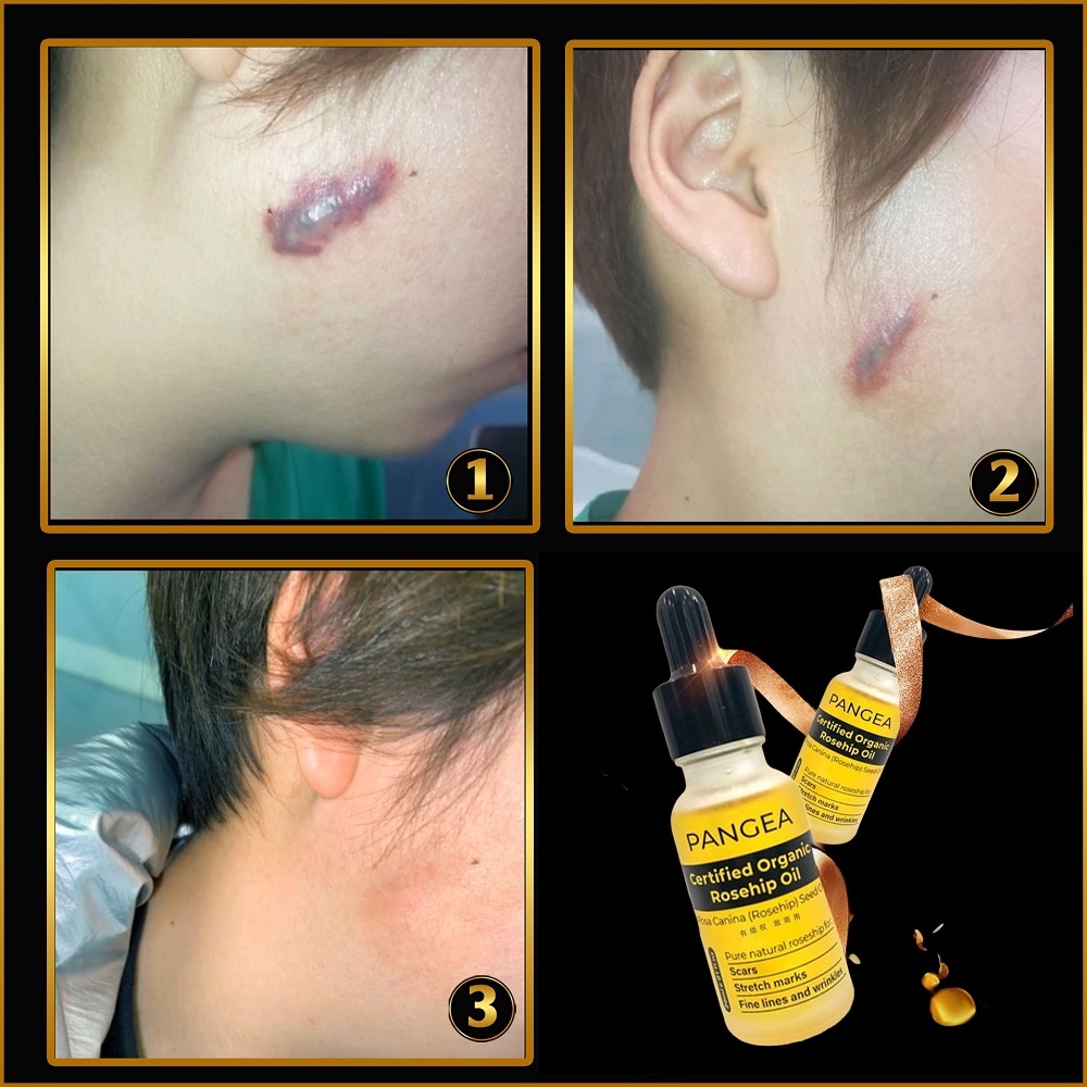 [HCM]Serum PANGEA - Xóa Sẹo Chuyên Sâu 20ml