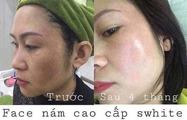 [HCM]KEM FACE NÁM CAO CẤP SWHITE