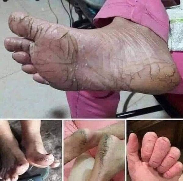 KEM TRỊ NỨT GÓT CHÂN KPEM APTEKA NGA - DATE 2025