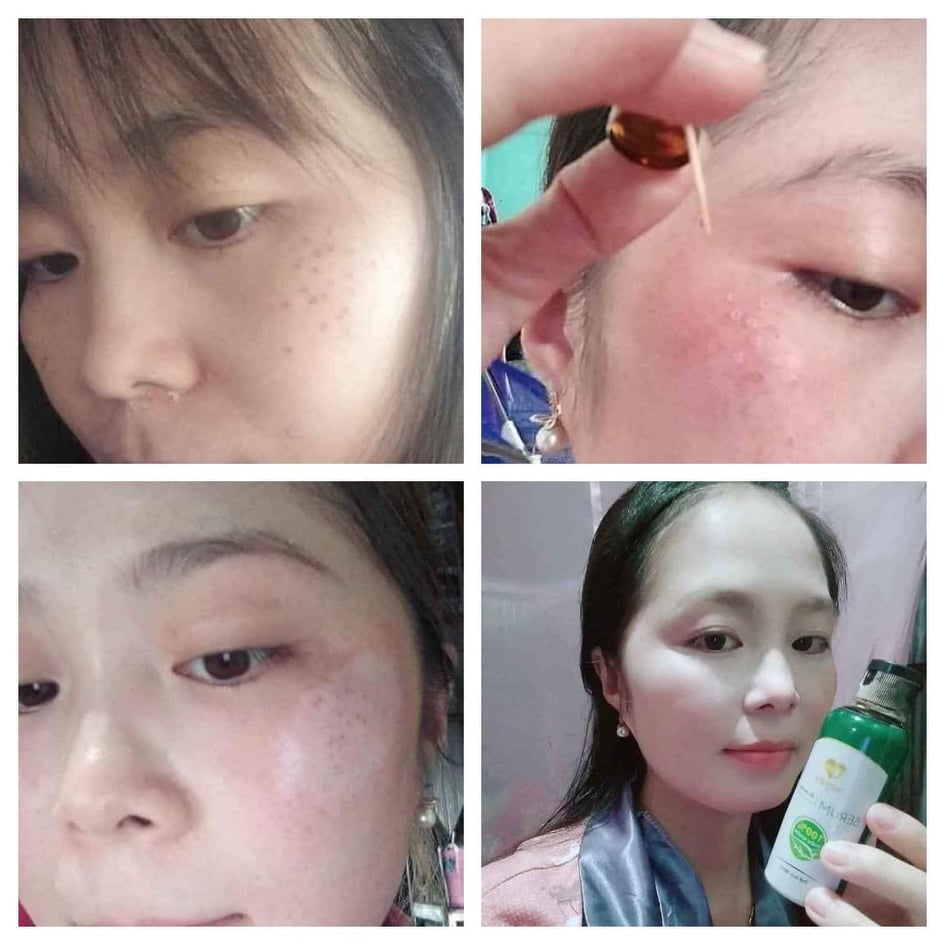 [TẶNG ẤM SIÊU TỐC +CHAI NƯỚC HOA PHÁP 20ML]-COMBO CHẤM TÀN NHANG,MỤN THỊT,MỤN RUỒI,MỤN CÓC 7 NGÀY BONG