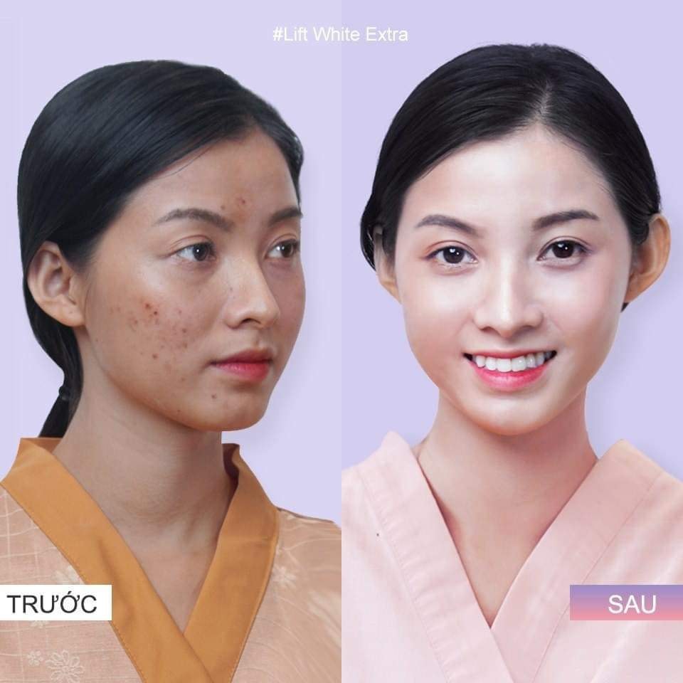 [ CHẤM NÁM ] Chấm nám tàn nhang, nám chân sâu ( ko hộp giấy)