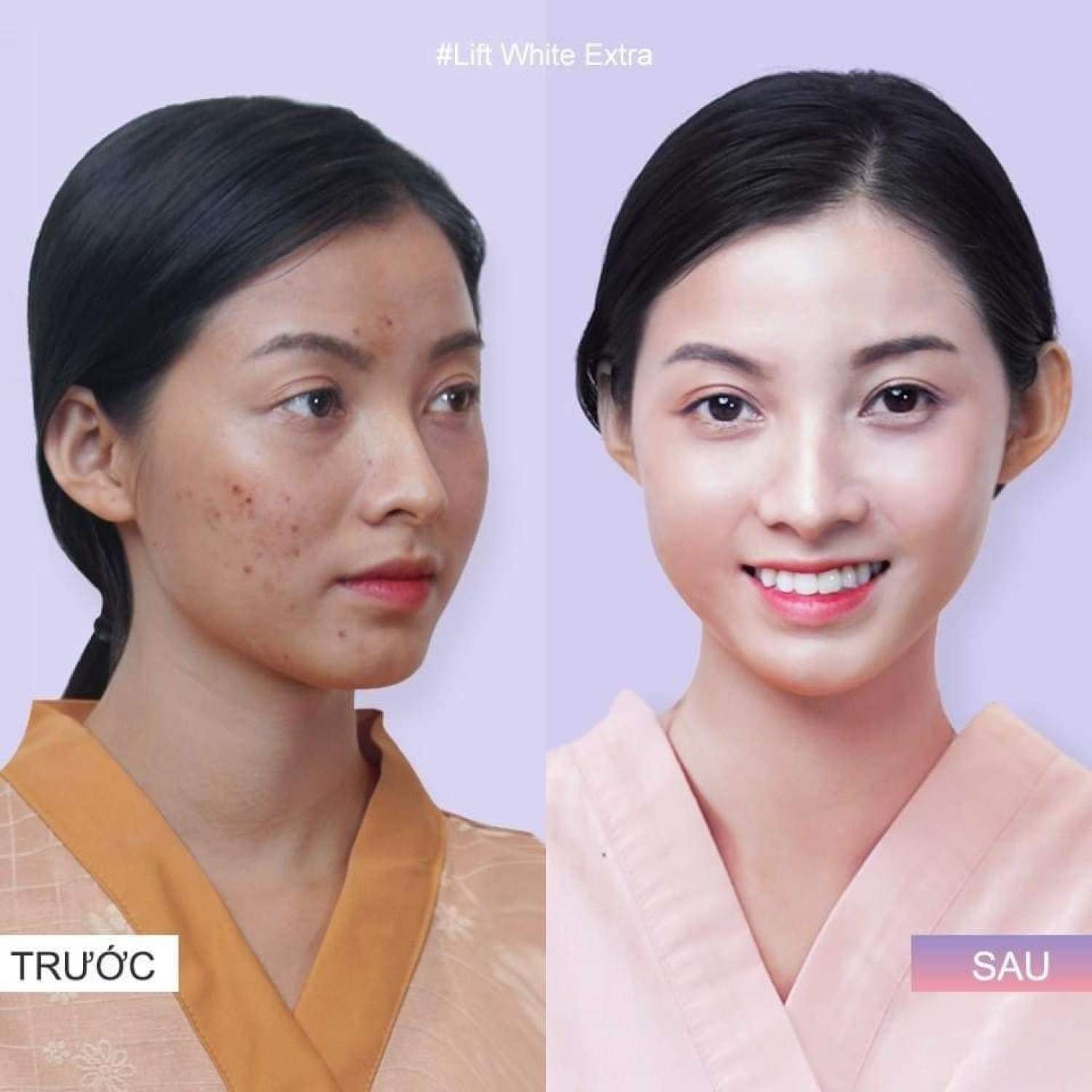 [ CHẤM na'M ] Chấm na'm tàn nhang, na'm chân sâu ( ko hộp giấy)