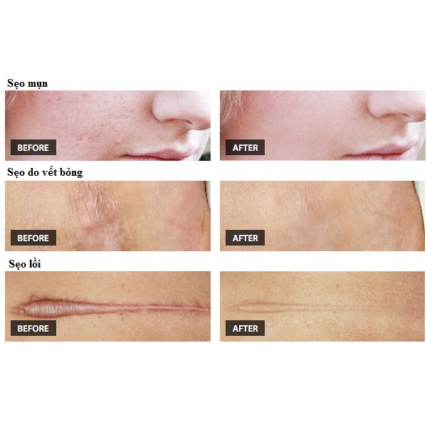 [HCM]Gel trị sẹo MEDERMA Advanced Scar Gel ( 20g )