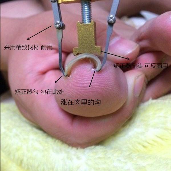 Dụng cụ chữa móng quặp móng chân chọc thịt đau đớn