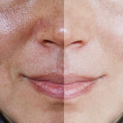 10 vĩ cao nám whoo mờ thâm nám sạm tàn nhang