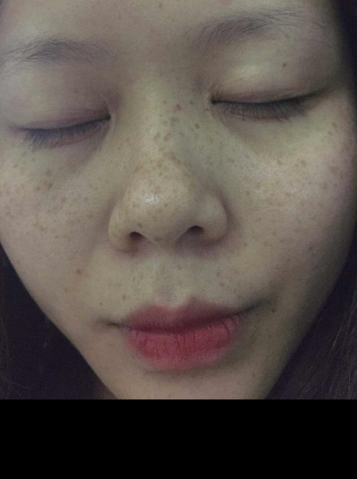 Cỏ trị nám, tàn nhang Lý Gia .