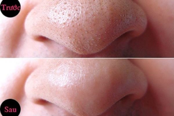 [HCM]Gel lột mụn TiTiOne 15gr