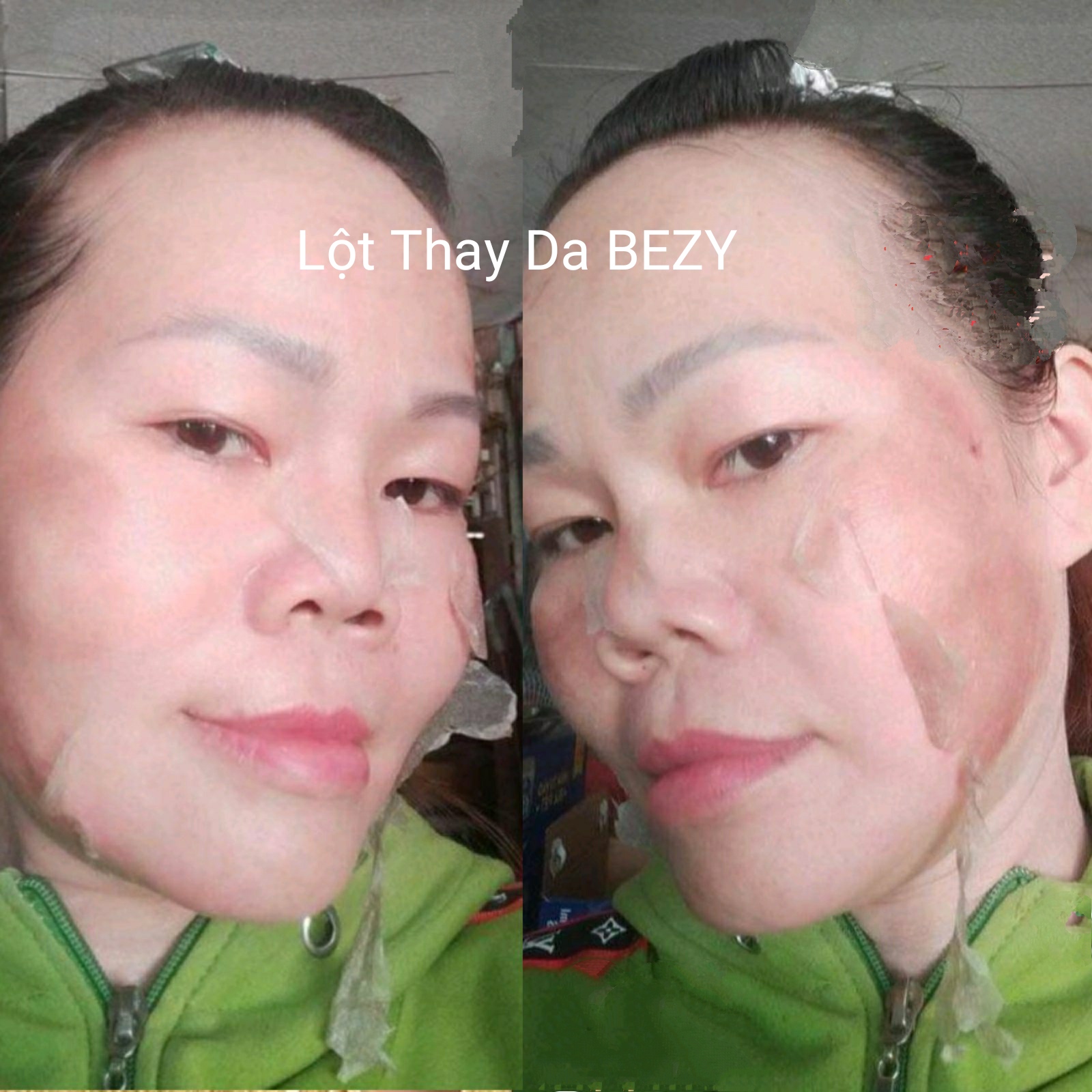 BEZY Lột Thay Trắng Da Mờ Thâm Nám Thái Lan