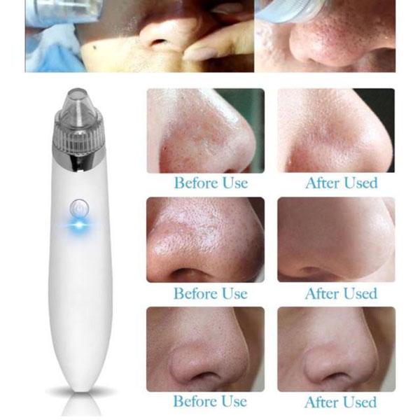 Máy Hút Mụn Mini Cầm Tay 5 Chế Độ Hút