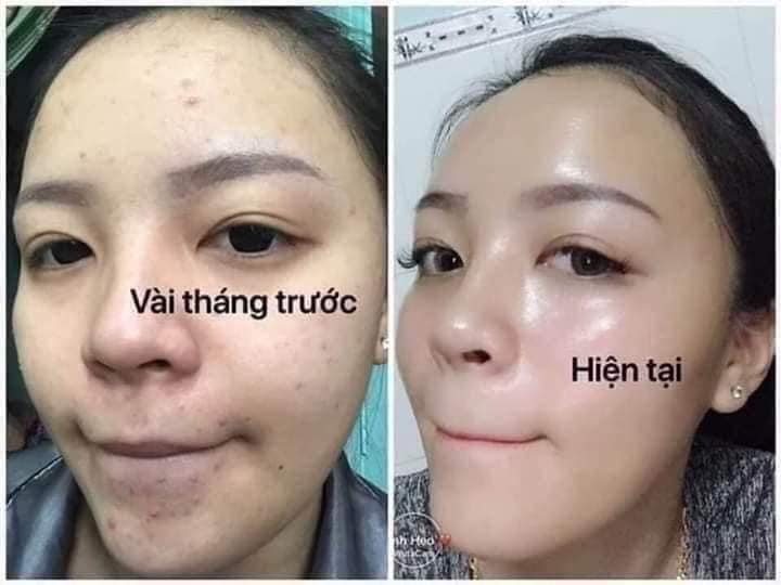 Bộ Nám Cao Cấp CLOBETAMIL-G Thái Lan