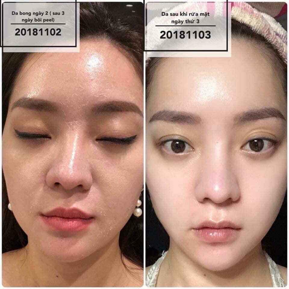 DERMAPEEL TRỨNG CÁ TUYẾT HÀN QUỐC