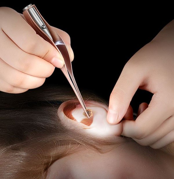 Đồ ngoáy tai, bé bị ráy tai khô