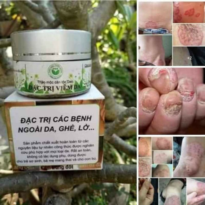 THẢO MỘC BÔI DA THIÊN NHIÊN TKH
