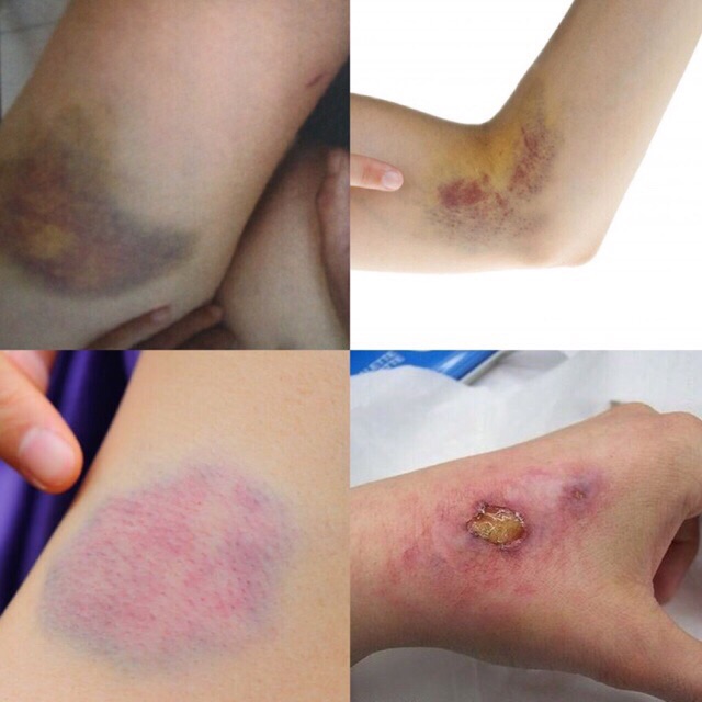 HIỆU ỨNG VẾT THƯƠNg- HOÁ TRANG HALLOWEEN - VẾT THƯƠNG BỊ BẦM