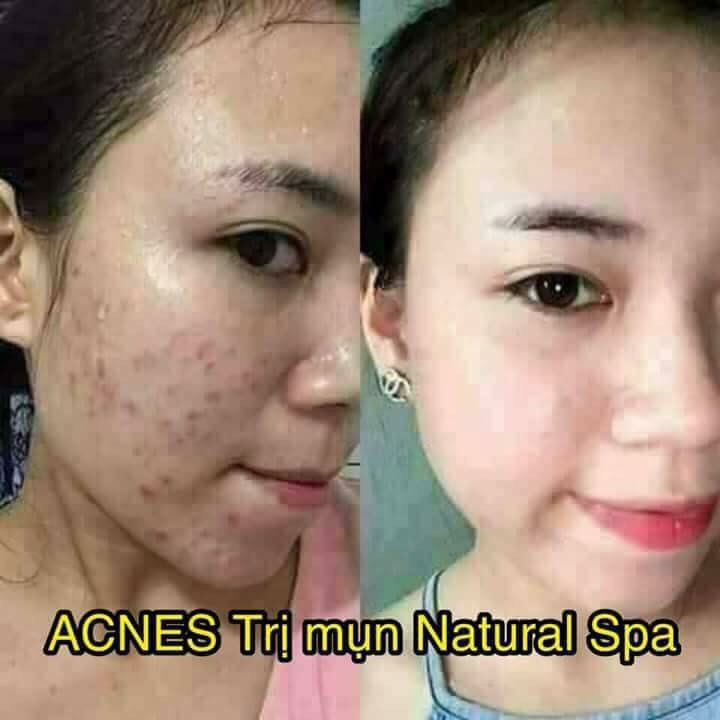 Kem Ngăn Ngừa Mụn Acne Dr Cell 30g dưỡng trắng mờ thâm mụn giảm mụn ngăn ngừa mụn