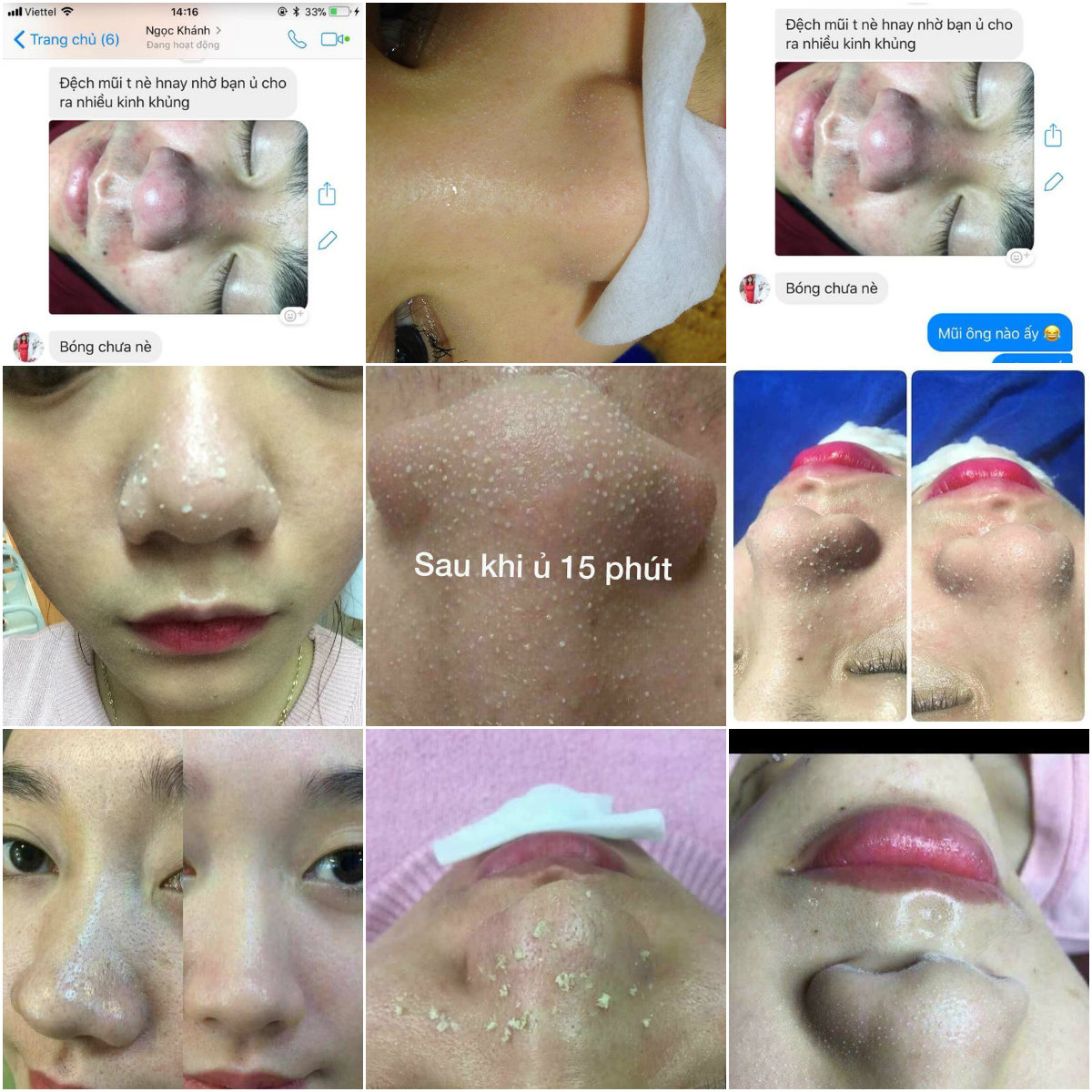 Ủ Mụn Cám Mụn Đầu Đen Hàn Quốc