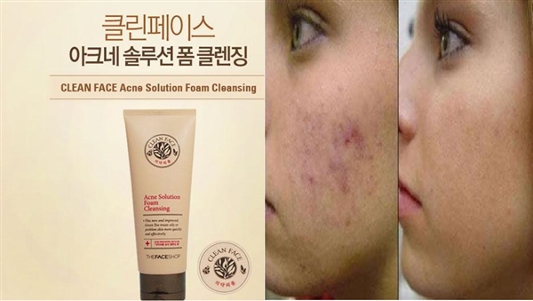 Sữa rửa mặt sạch nhờn, ngừa mụn TheFaceShop Acne Solution 150ml