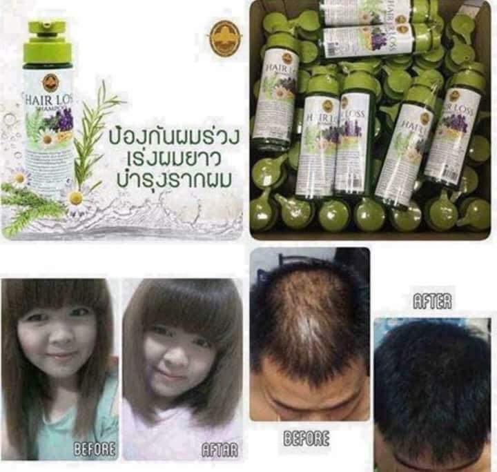 [HCM]Dầu gội kích thích mọc tóc số 1 tại Thái