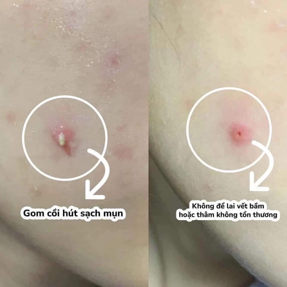[HCM]Miếng Dán Mụn Cosrx Acne Pimple Master Patch