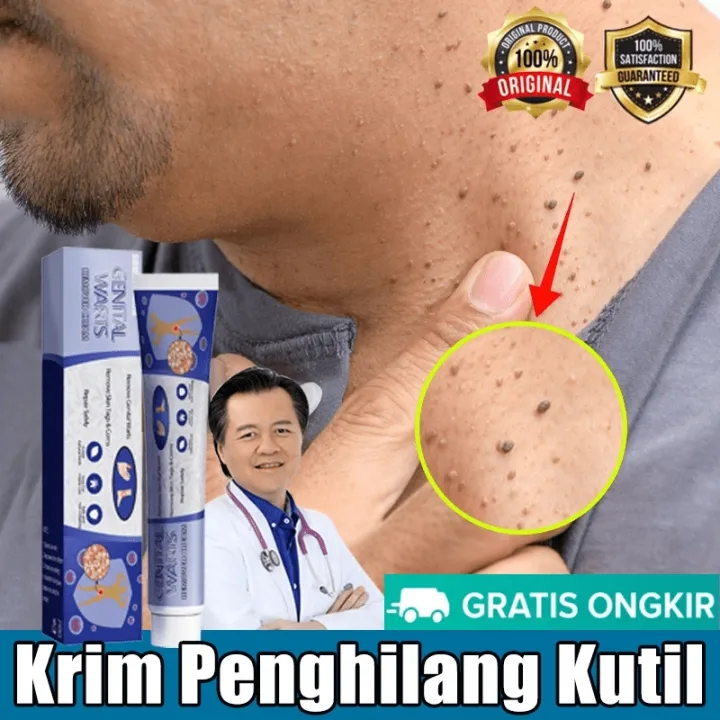 South Moon Wart Removal Cream kem mụn cóc Gel tẩy nốt ruồi mụn cóc mụn thịt mụn mụn thit Nhanh chóng và hiệu quả Nhẹ nhàng và không gây kích ứng祛疣膏痤疮疤痕膏20g