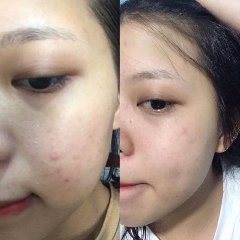 KEM TRỊ MỤN HT BEAUTY