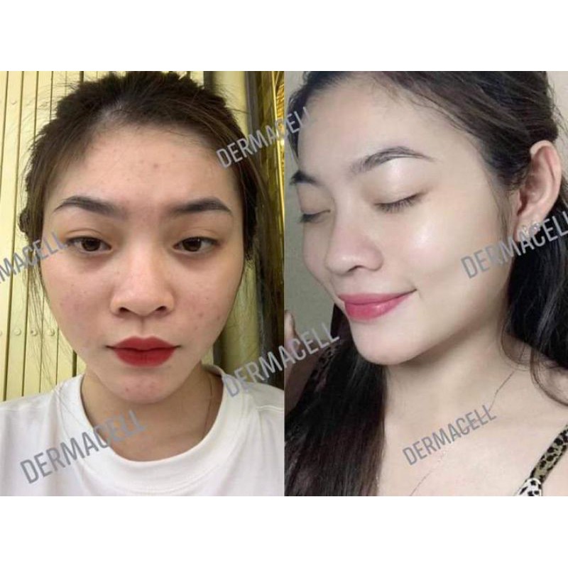 Serum Remex7 Tế bào gốc thực vật