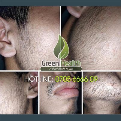 Minoxidil 5% Foam for Beard and Hair Growth