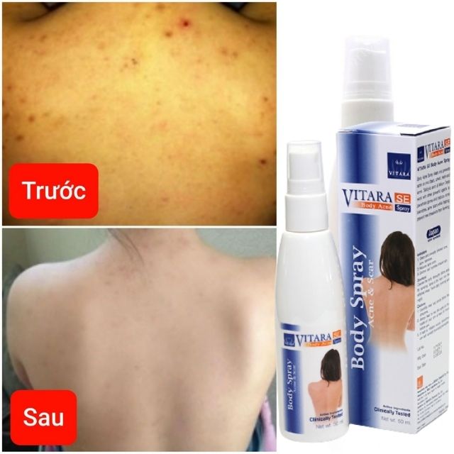 Xịt loại bỏ mụn lưng thái lan vitara 50gr