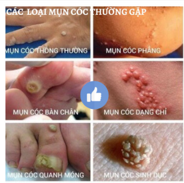 {ĐÁNH BẬT} MỤN CÓC, MỤN THỊT REMOVE EVERY WARTS