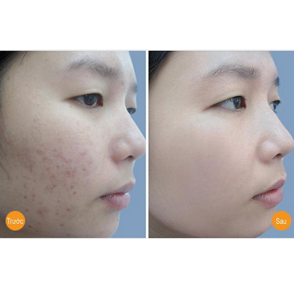 [HCM]Kem mụn Ngân Bình