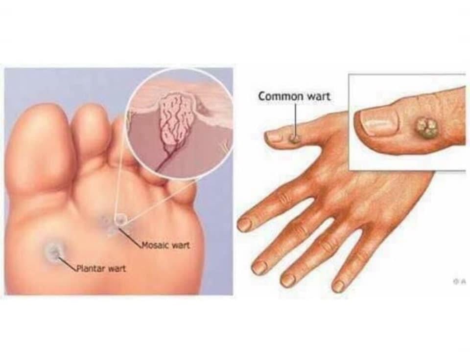 CON CON Bôi Mụn Cóc Thái Lan 15ml