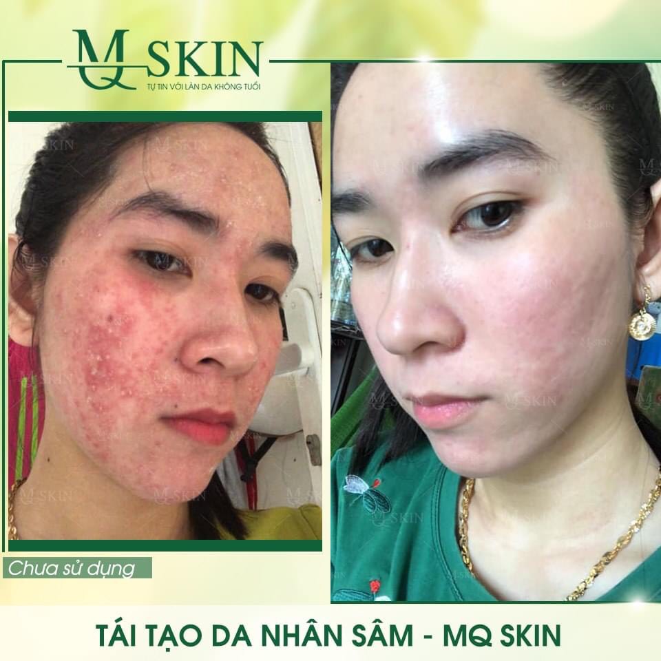 [FREESHIP + QUÀ TẶNG] - SERUM TÁI TẠO THAY DA NHÂN SÂM MQSKIN (HÀNG CHÍNH HÃNG)