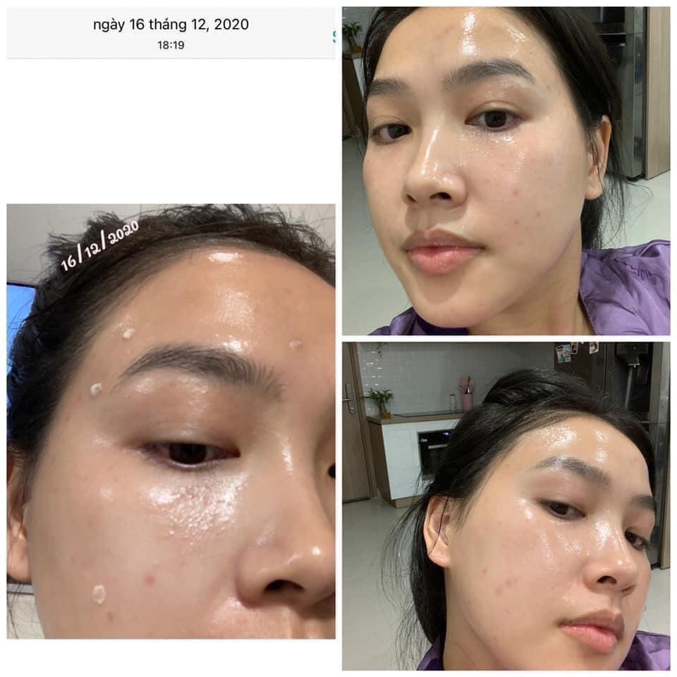 [ Bill hãng ] Thanh tẩy da AHA 30% + BHA 2% Peeling Solution - The Ordinary