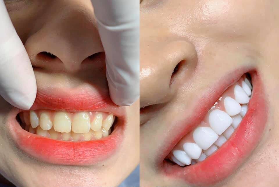 đèn chiếu đính đá răng+phủ răng sứ 99s ánh sáng mạnh x5