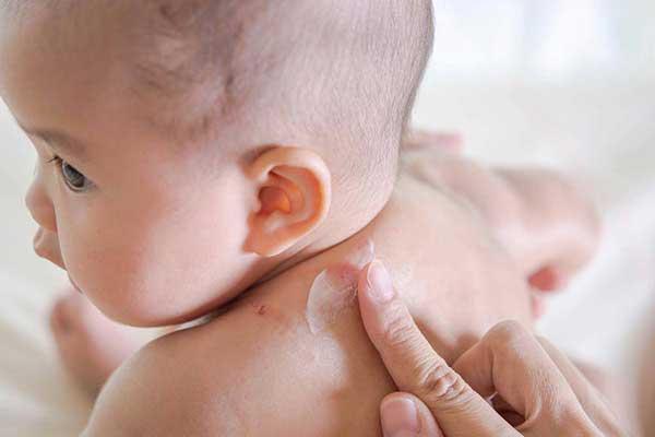 KEM CHỐNG HĂM TÃ SUDOCREM
