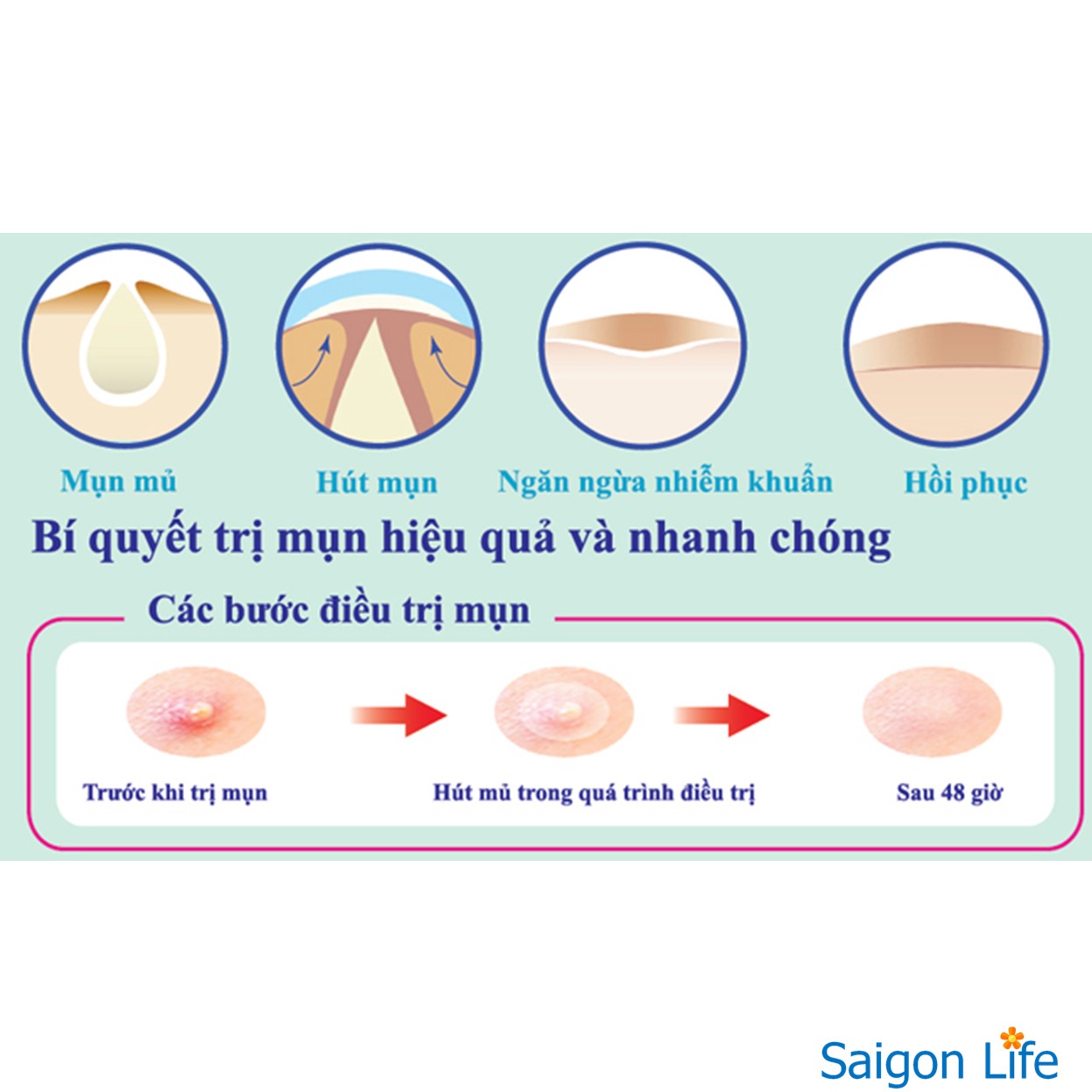 Miếng Dán Giảm Mụn Mayancare 20 Miếng (Hộp Xanh)