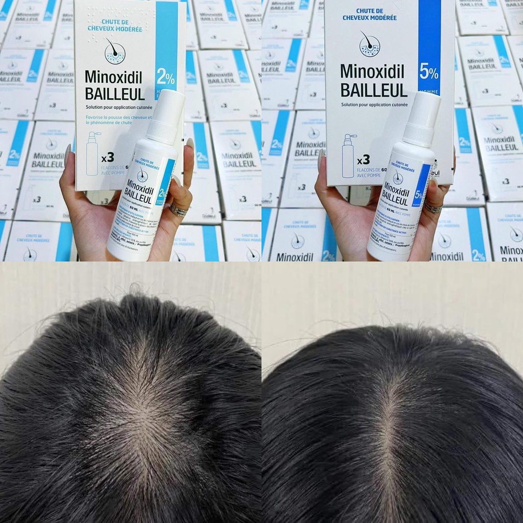 Xịt Mọc Tóc MINOXIDIL BAILLEUL 2% 5% - NGĂN RỤNG TÓC KÍCH THÍCH MỌC TÓC [Hộp 3 lọ 60ml]