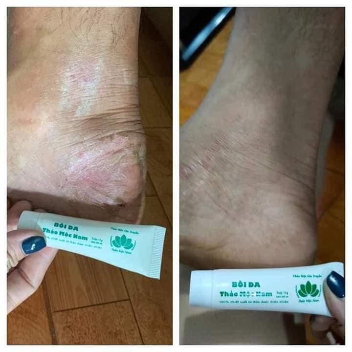 [HCM]Kem bôi da Thảo Mộc Nam