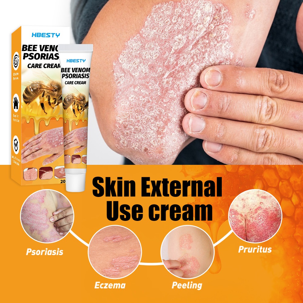 Kem bôi nọc ong hbesty, kem bôi nọc ong tiêu mụn nước, chàm eczema hbesty - giảm ngứa tiêu mụn tiêu viêm, á sừng 20g
