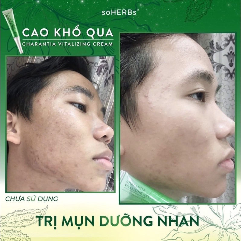 Cao Khổ Qua soHERBs Dành Cho Da Mụn Trắng Da 10ml
