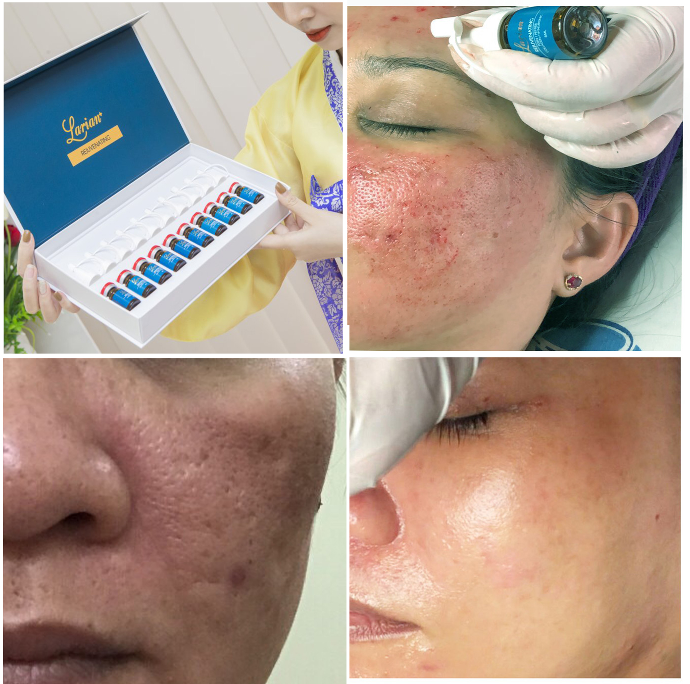 REJUVENATING DNA LARIAN+(SERUM TẾ BÀO GỐC TRỊ SẸO HÀN QUỐC ) 1 SET 10 LỌ X 8 ML.
