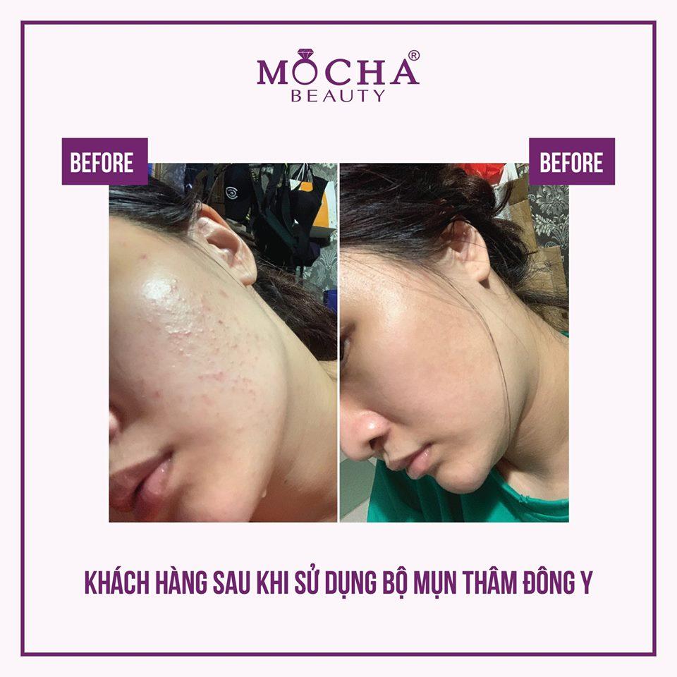 Kem Mụn - Bộ MỤN MOCHA 60gram gồm 2 hộp
