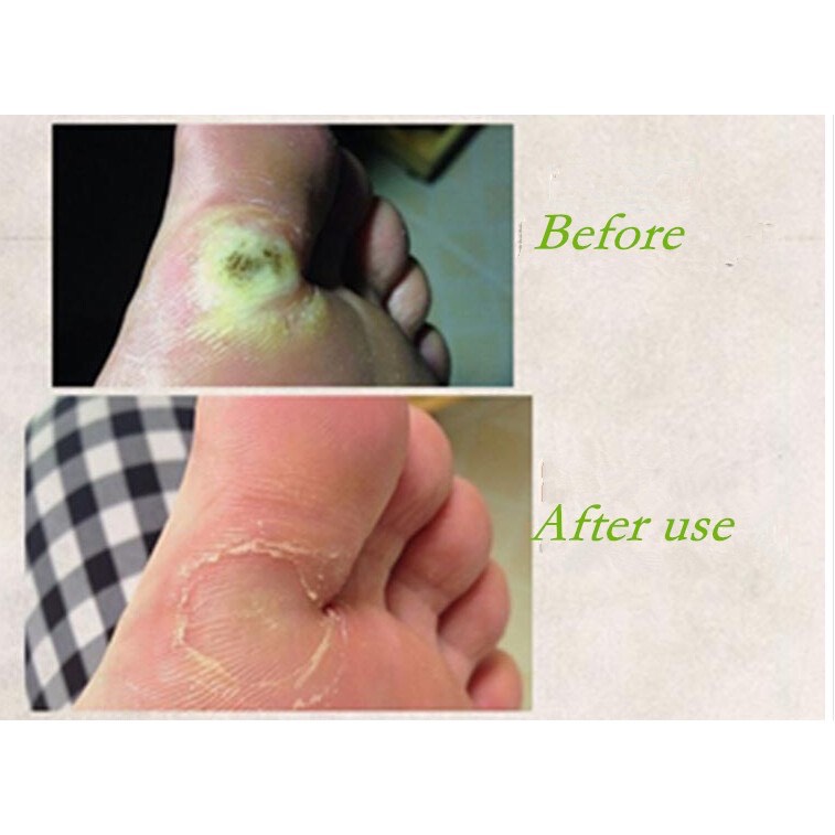Miếng dán Plasters - Miếng dán Mụn cóc Mắt cá chân Vết Chai (Hộp 18 miếng)