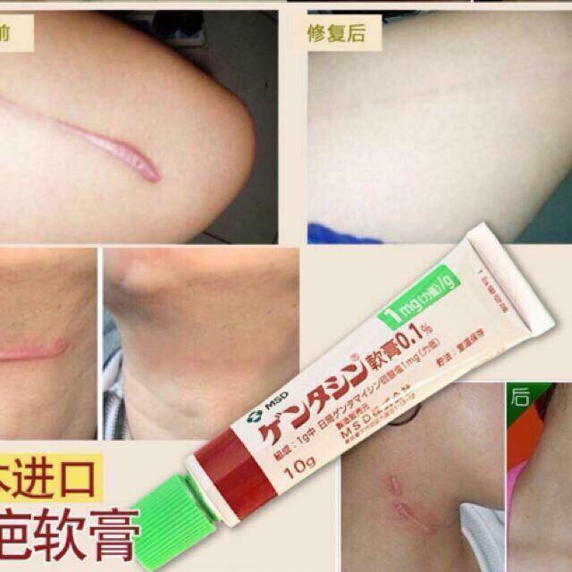 [HCM]Gel trị Sẹo Gentacin Nhật Tuýp 10g