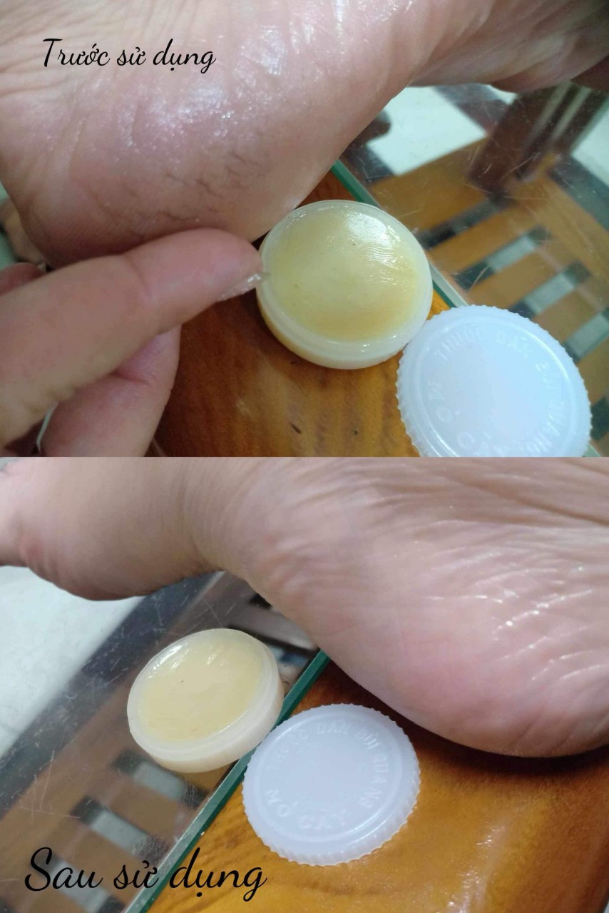 Kem bôi Bùi Quang Mỏ Cày, nứt gót chân, nước ăn chân, vảy nến, hâm tã cho trẻ
