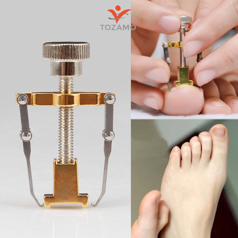 Dụng Cụ Chỉnh Hình Móng Chân Mọc Ngược Móng Quặp tozamo
